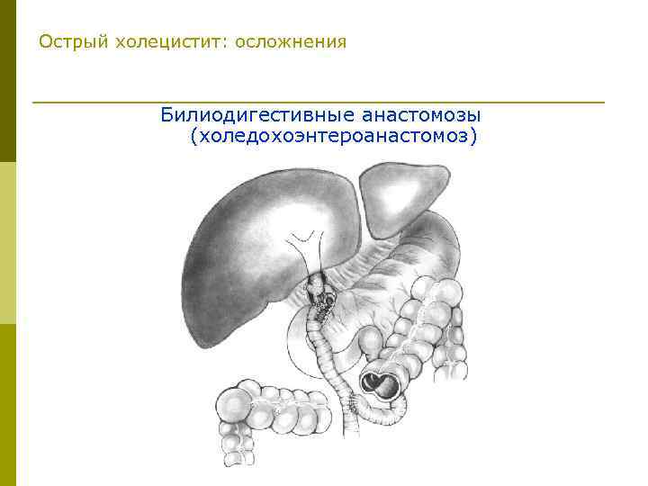 Этиология острого холецистита картинки