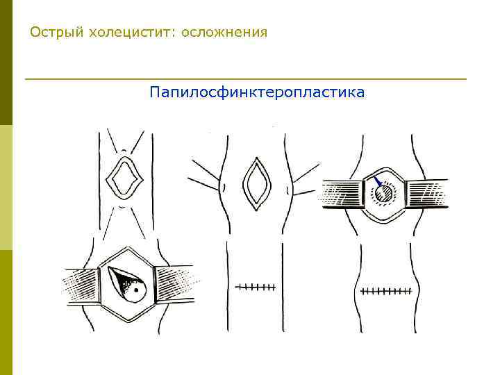 Острый холецистит: осложнения Папилосфинктеропластика 