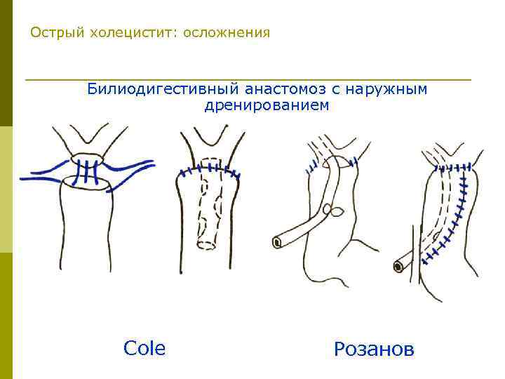 Острый холецистит карта