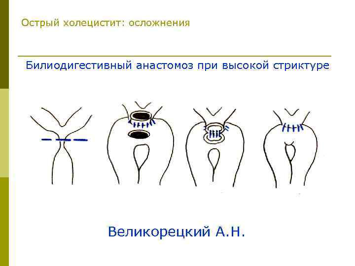 Острый холецистит: осложнения Билиодигестивный анастомоз при высокой стриктуре Великорецкий А. Н. 