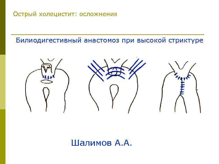 Острый холецистит: осложнения Билиодигестивный анастомоз при высокой стриктуре Шалимов А. А. 