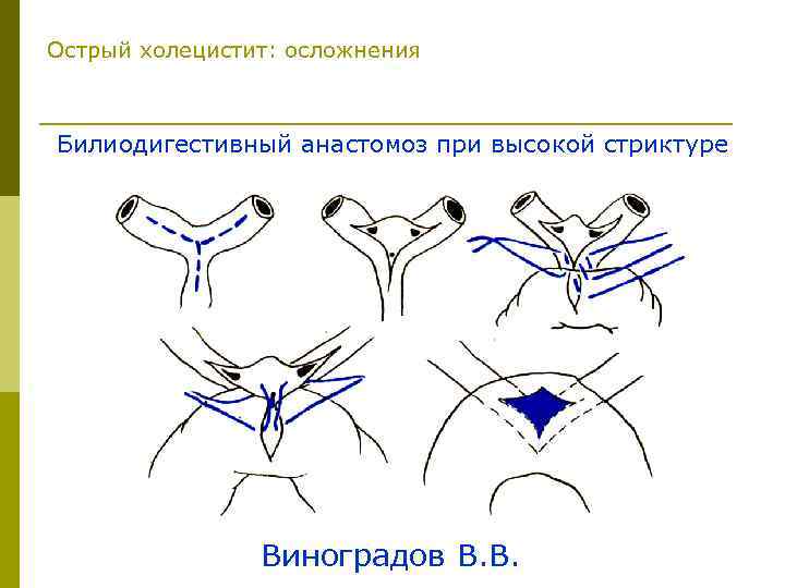 Острый холецистит: осложнения Билиодигестивный анастомоз при высокой стриктуре Виноградов В. В. 
