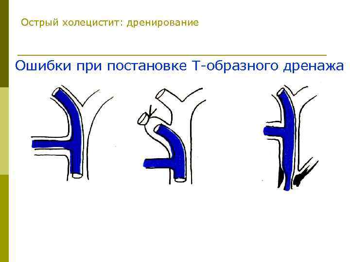 Острый холецистит: дренирование Ошибки при постановке Т-образного дренажа 