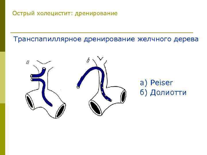 Острый холецистит: дренирование Транспапиллярное дренирование желчного дерева а) Peiser б) Долиотти 