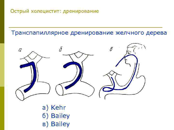 Острый холецистит карта смп