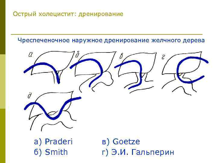 Острый холецистит: дренирование Чреспеченочное наружное дренирование желчного дерева а) Praderi б) Smith в) Goetze