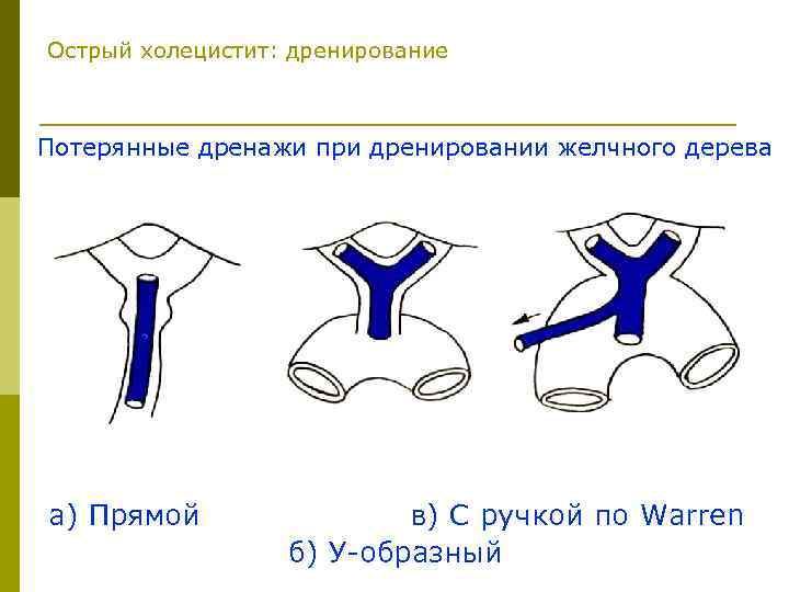 Острый холецистит: дренирование Потерянные дренажи при дренировании желчного дерева а) Прямой в) С ручкой