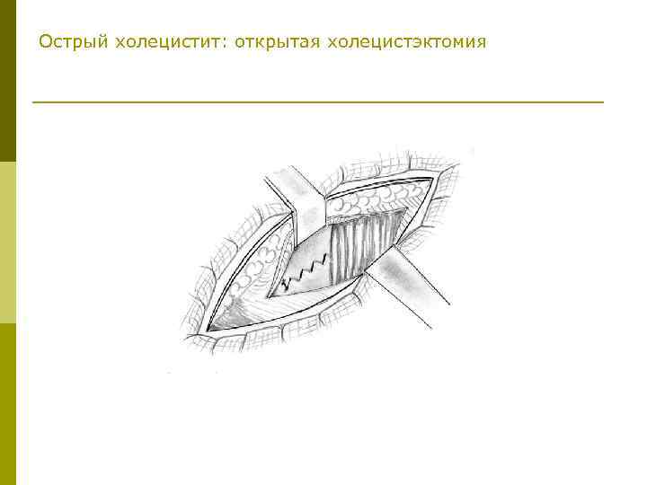 Острый холецистит: открытая холецистэктомия 