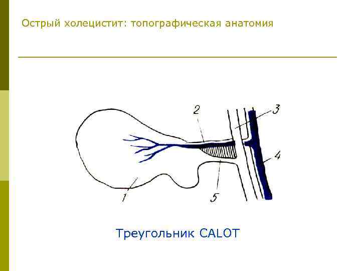 Острый холецистит: топографическая анатомия Треугольник CALOT 