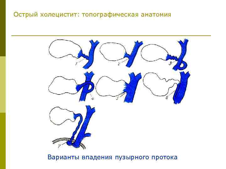 Острый холецистит: топографическая анатомия Варианты впадения пузырного протока 