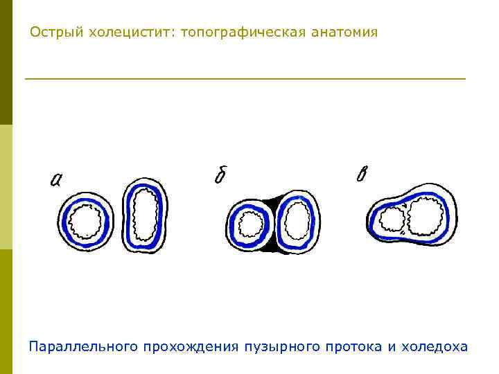 Острый холецистит: топографическая анатомия Параллельного прохождения пузырного протока и холедоха 