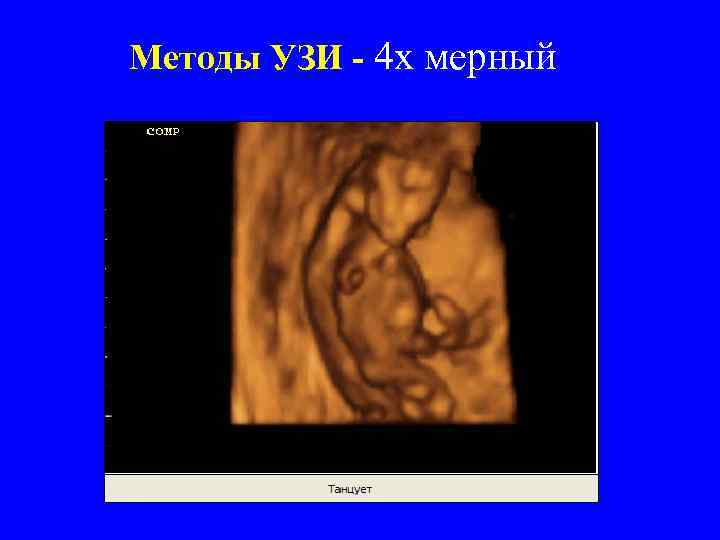 Методы УЗИ - 4 х мерный 