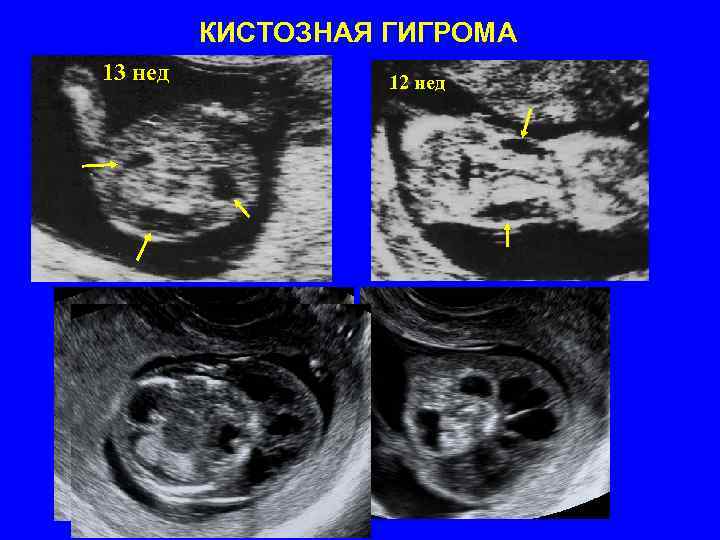 КИСТОЗНАЯ ГИГРОМА 13 нед 12 нед 