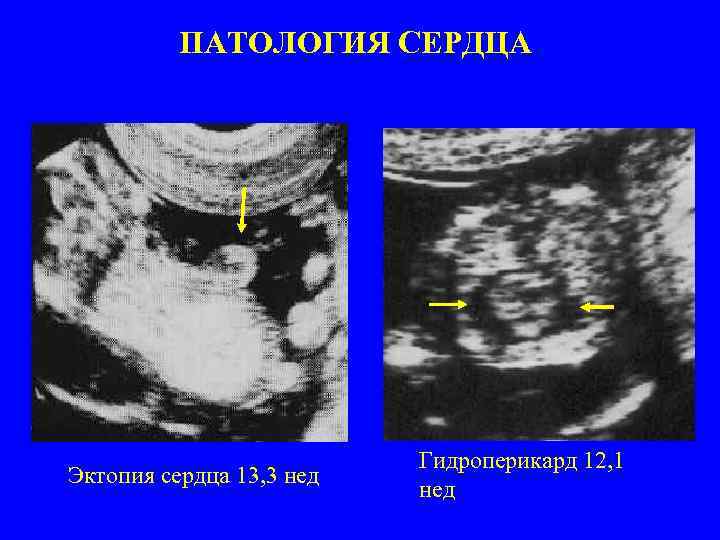 ПАТОЛОГИЯ СЕРДЦА Эктопия сердца 13, 3 нед Гидроперикард 12, 1 нед 