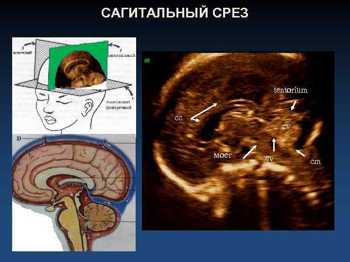 САГИТАЛЬНЫЙ СРЕЗ tentorium cc cv мост 4 v cm 