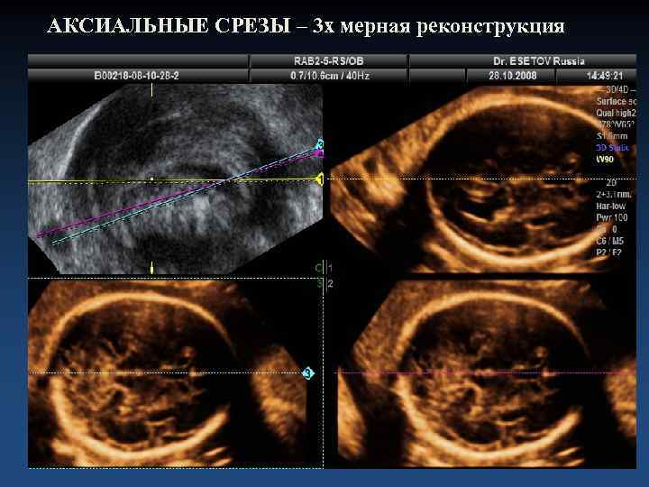 АКСИАЛЬНЫЕ СРЕЗЫ – 3 х мерная реконструкция 