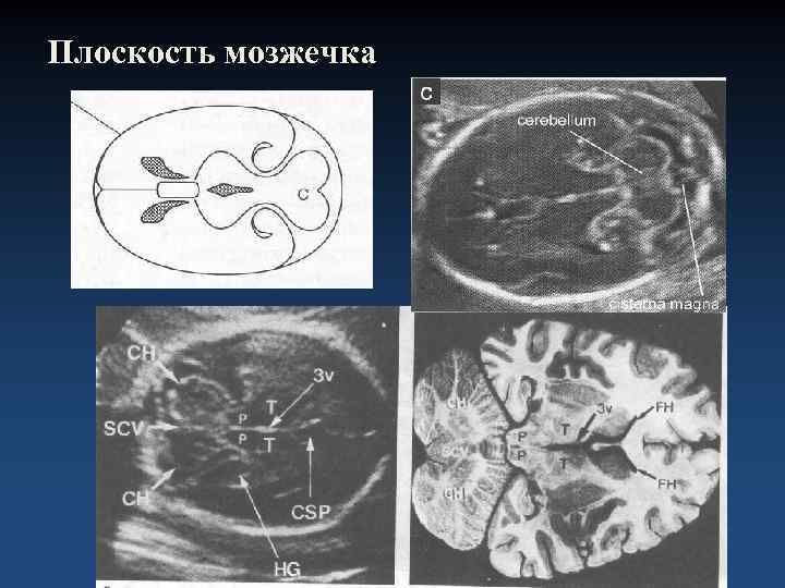 Плоскость мозжечка 
