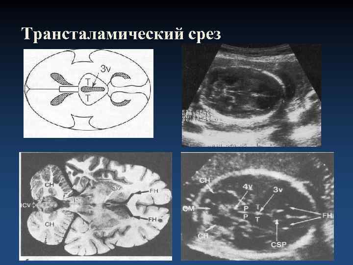 Трансталамический срез 