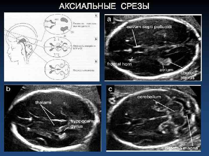 АКСИАЛЬНЫЕ СРЕЗЫ 