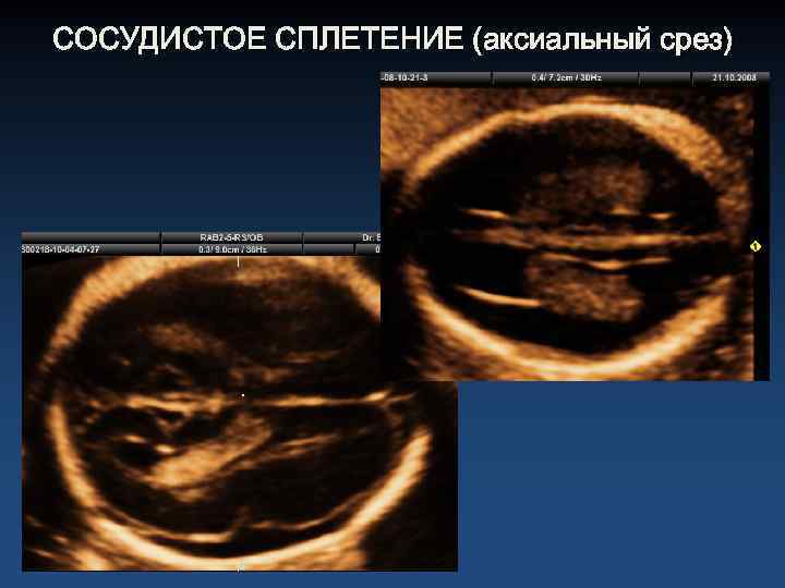 СОСУДИСТОЕ СПЛЕТЕНИЕ (аксиальный срез) 