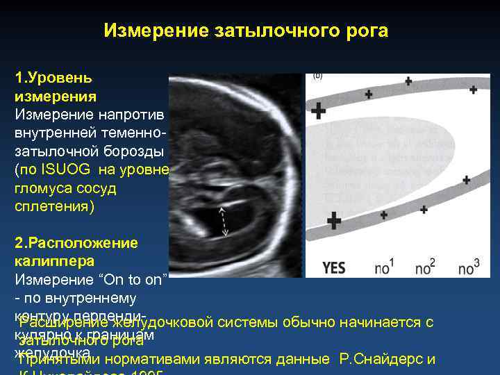 Измерение затылочного рога 1. Уровень измерения Измерение напротив внутренней теменнозатылочной борозды (по ISUOG на