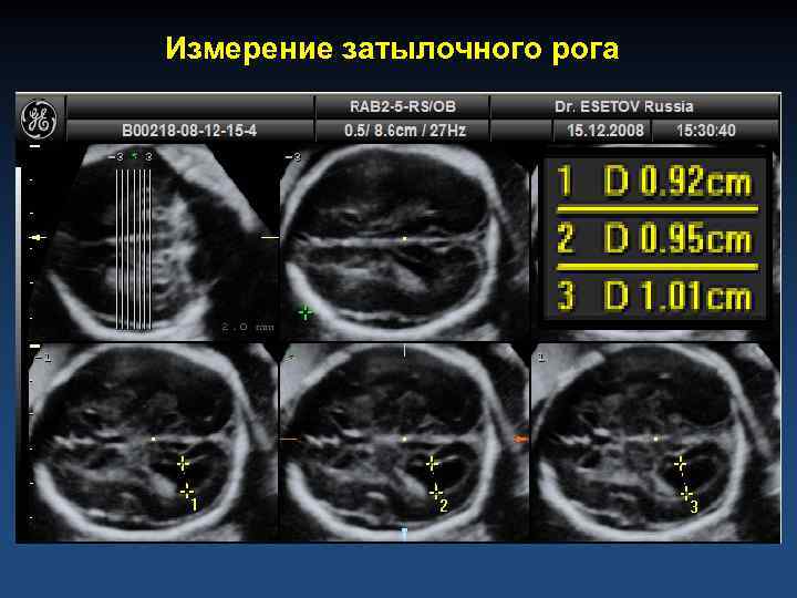 Измерение затылочного рога 