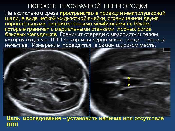 Полость прозрачной перегородки. Полость прозрачной перегородки головного мозга у плода норма. Полость прозрачной перегородки норма УЗИ. Полость прозрачной перегородки расширение УЗИ. Полость прозрачной перегородки нейросонография.