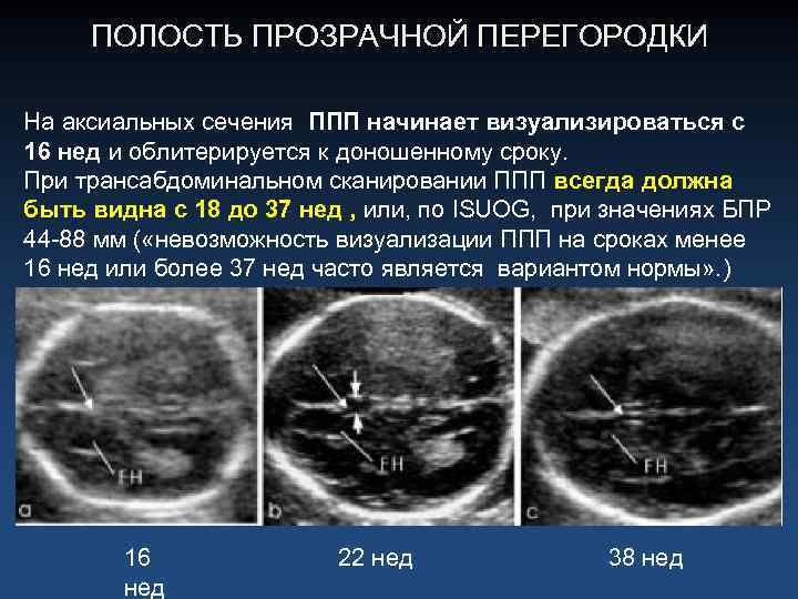 Полость прозрачной перегородки. Полость прозрачной перегородки головного мозга у плода норма. Полость прозрачной перегородки головного мозга полость Верге. Полость прозрачной перегородки головного мозга на УЗИ. Киста полости Верге УЗИ.