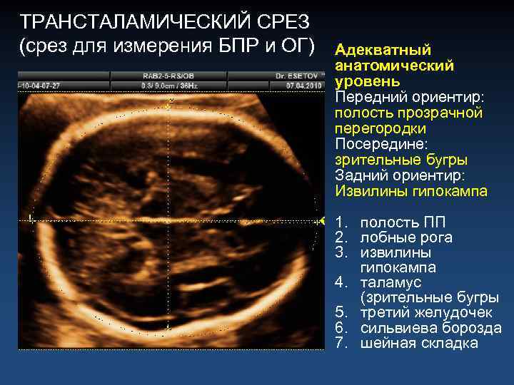 Полость прозрачной перегородки. Полость прозрачной перегородки на УЗИ. Полость прозрачной перегородки на УЗИ плода. Срезы в УЗИ. Полость прозрачной перегородки у плода норма.