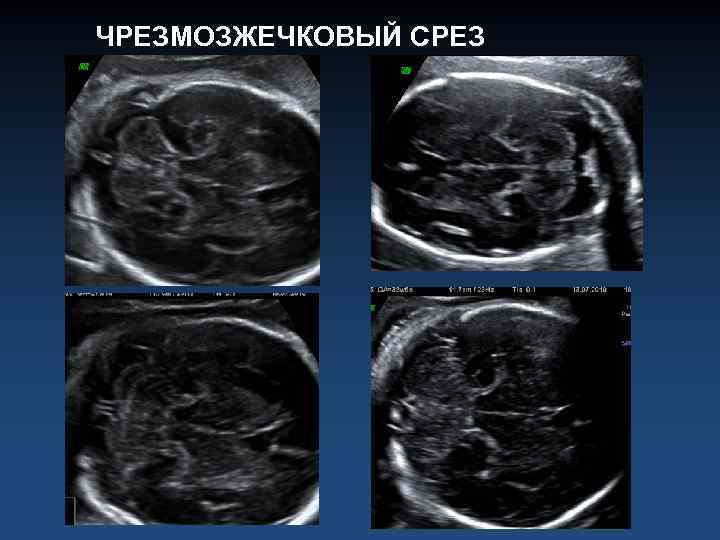 ЧРЕЗМОЗЖЕЧКОВЫЙ СРЕЗ 