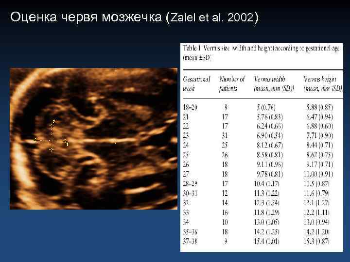Оценка червя мозжечка (Zalel et al. 2002) 