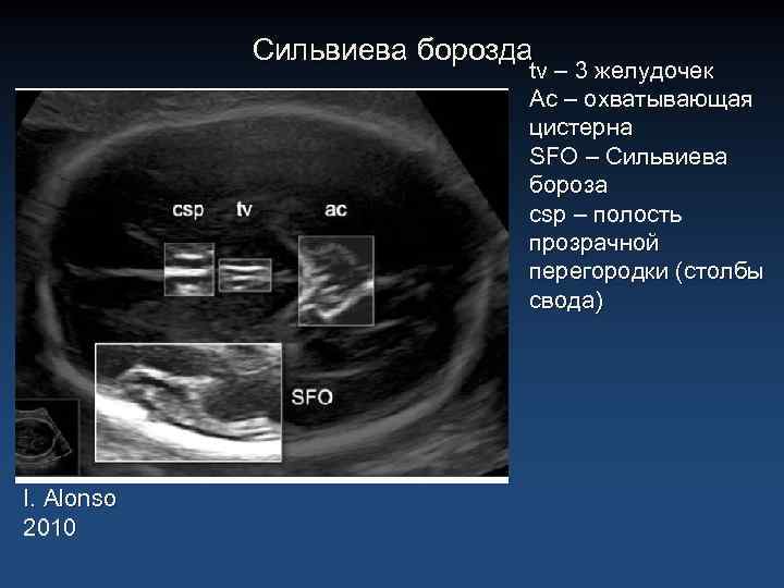 Сильвиева борозда tv – 3 желудочек Ас – охватывающая цистерна SFO – Сильвиева бороза