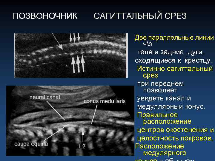 ПОЗВОНОЧНИК САГИТТАЛЬНЫЙ СРЕЗ Две параллельные линии чз тела и задние дуги, сходящиеся к крестцу.