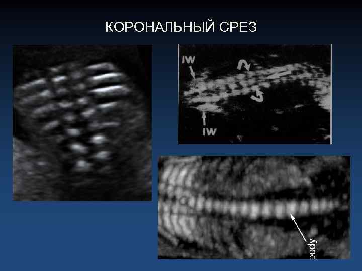 КОРОНАЛЬНЫЙ СРЕЗ 