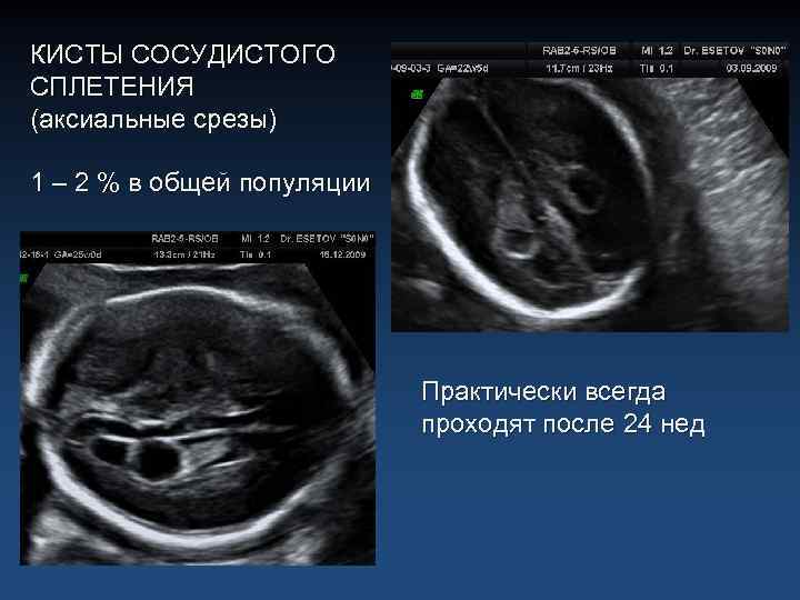 КИСТЫ СОСУДИСТОГО СПЛЕТЕНИЯ (аксиальные срезы) 1 – 2 % в общей популяции Практически всегда