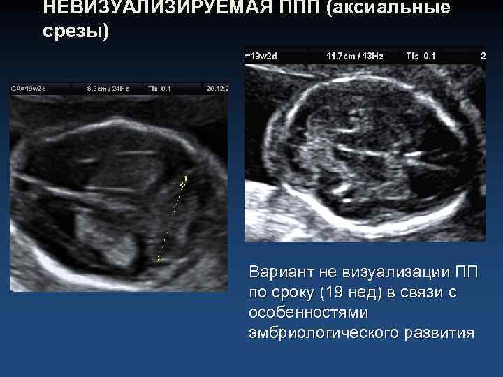 НЕВИЗУАЛИЗИРУЕМАЯ ППП (аксиальные срезы) Вариант не визуализации ПП по сроку (19 нед) в связи
