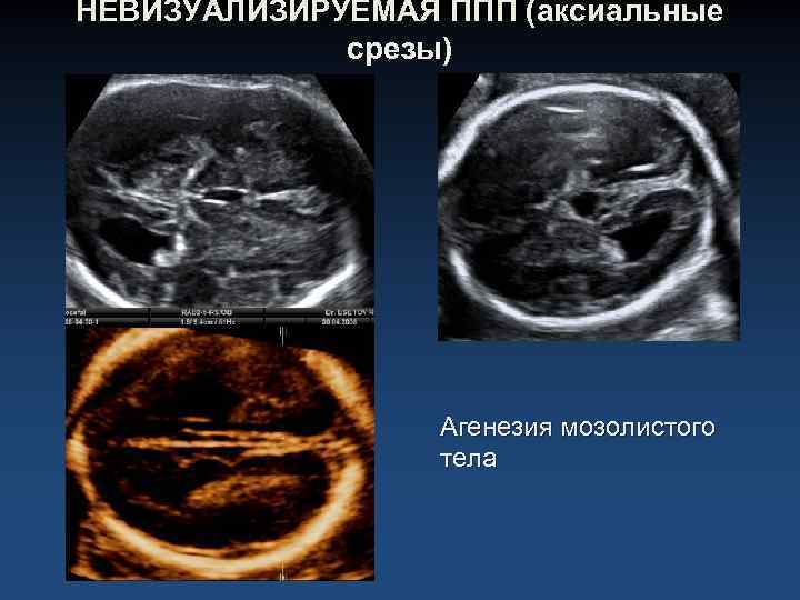 НЕВИЗУАЛИЗИРУЕМАЯ ППП (аксиальные срезы) Агенезия мозолистого тела 