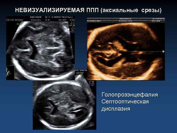 НЕВИЗУАЛИЗИРУЕМАЯ ППП (аксиальные срезы) Голопрозэнцефалия Септооптическая дисплазия 