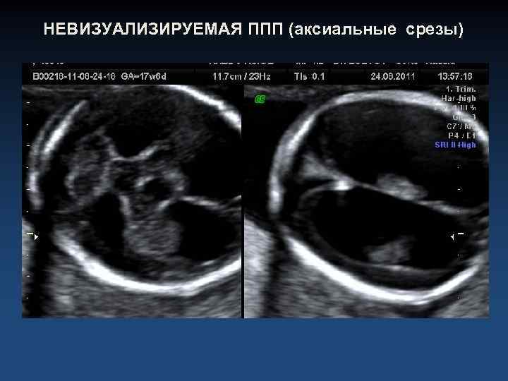 НЕВИЗУАЛИЗИРУЕМАЯ ППП (аксиальные срезы) 