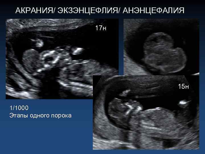 АКРАНИЯ/ ЭКЗЭНЦЕФЛИЯ/ АНЭНЦЕФАЛИЯ 17 н 15 н 1/1000 Этапы одного порока 