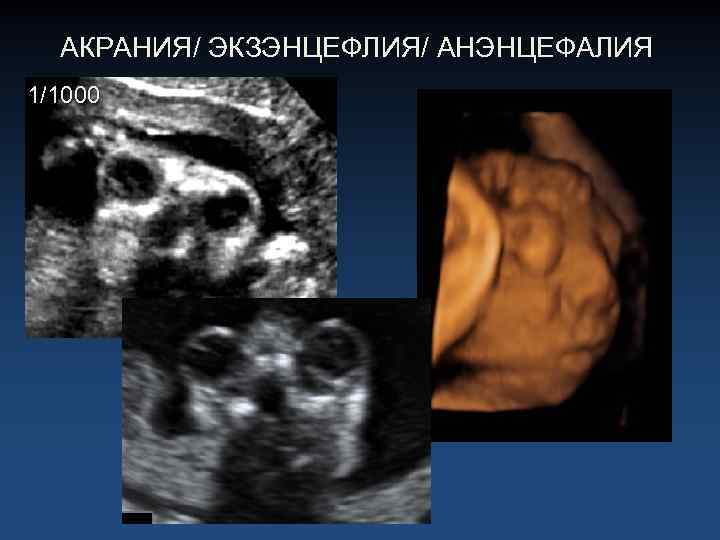 АКРАНИЯ/ ЭКЗЭНЦЕФЛИЯ/ АНЭНЦЕФАЛИЯ 1/1000 