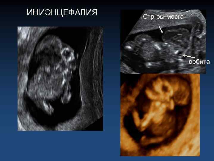 ИНИЭНЦЕФАЛИЯ Стр-ры мозга орбита 