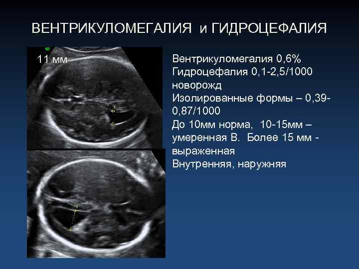 ВЕНТРИКУЛОМЕГАЛИЯ и ГИДРОЦЕФАЛИЯ 11 мм Вентрикуломегалия 0, 6% Гидроцефалия 0, 1 -2, 5/1000 новорожд