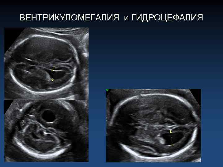 ВЕНТРИКУЛОМЕГАЛИЯ и ГИДРОЦЕФАЛИЯ 