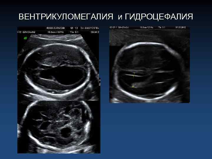 ВЕНТРИКУЛОМЕГАЛИЯ и ГИДРОЦЕФАЛИЯ 