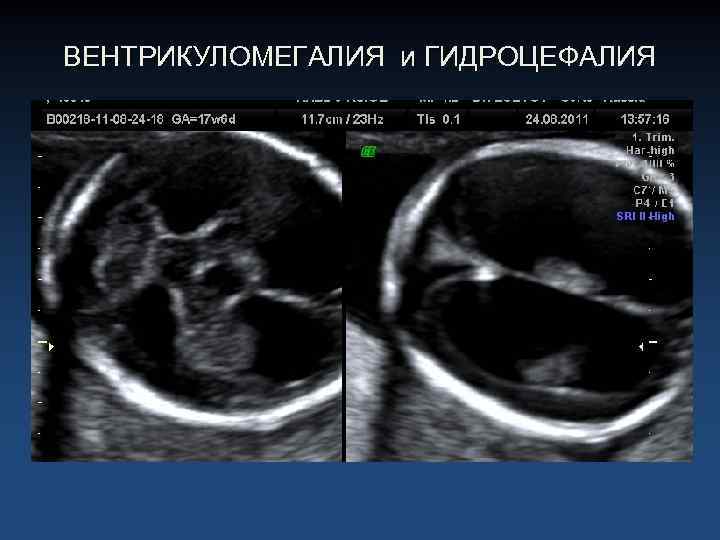 ВЕНТРИКУЛОМЕГАЛИЯ и ГИДРОЦЕФАЛИЯ 