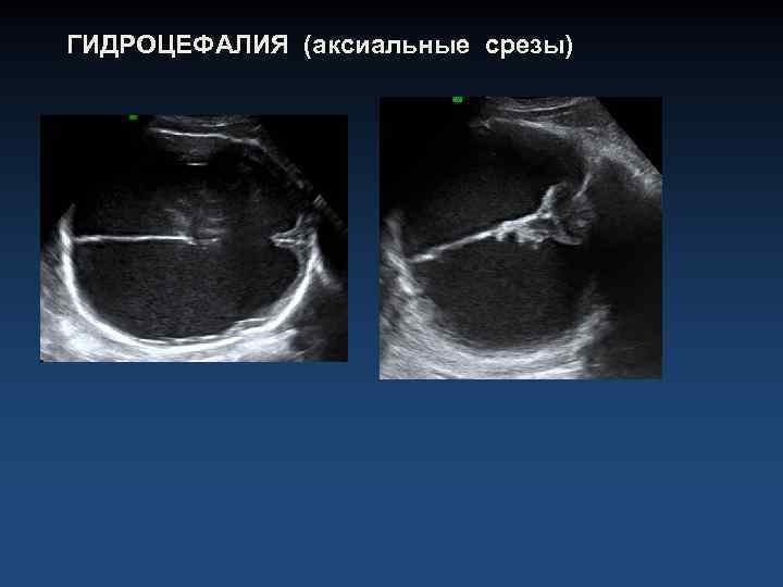 ГИДРОЦЕФАЛИЯ (аксиальные срезы) 