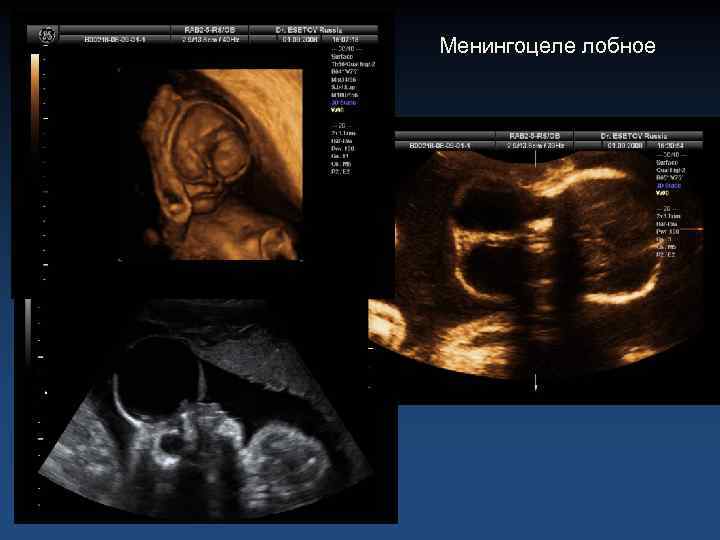 Менингоцеле лобное 