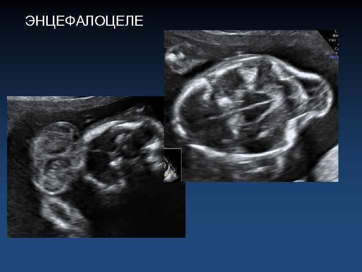 ЭНЦЕФАЛОЦЕЛЕ 