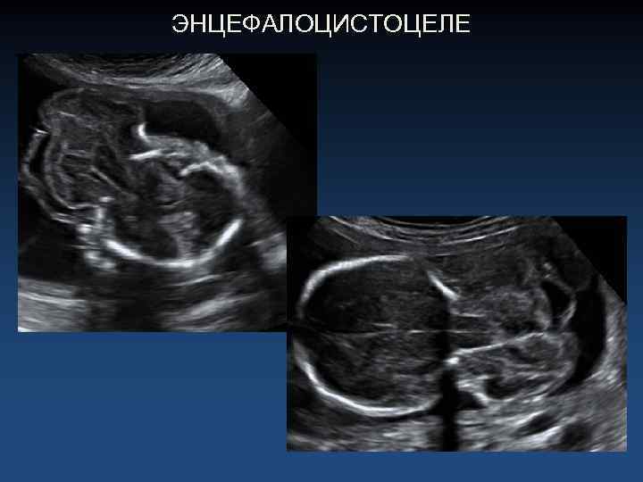 ЭНЦЕФАЛОЦИСТОЦЕЛЕ 